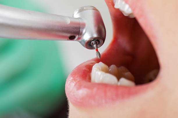 Best Emergency Dental Care for Broken or Chipped Teeth in Wauwatosa, WI